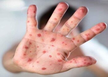 Cacar Monyet Sudah Masuk Indonesia, Dinkes Balikpapan Lakukan Antisipasi Dini