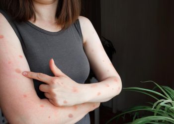 Tetap Waspada ! Temu Pastikan Tak Ada Virus Monkeypox di PPU