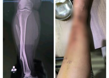 Korban Tabrak Lari di Jalan Pattimura Alami Patah Kaki